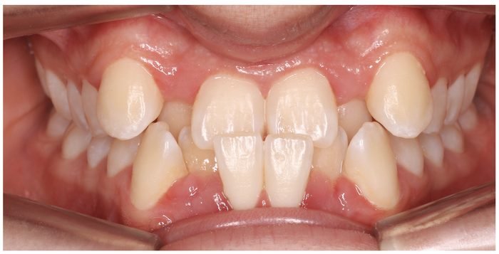 Antes: mordida cruzada en un paciente infantil
