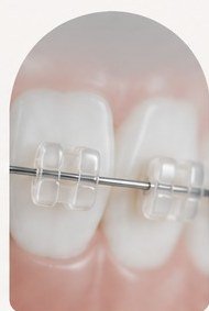 Brackets estéticos